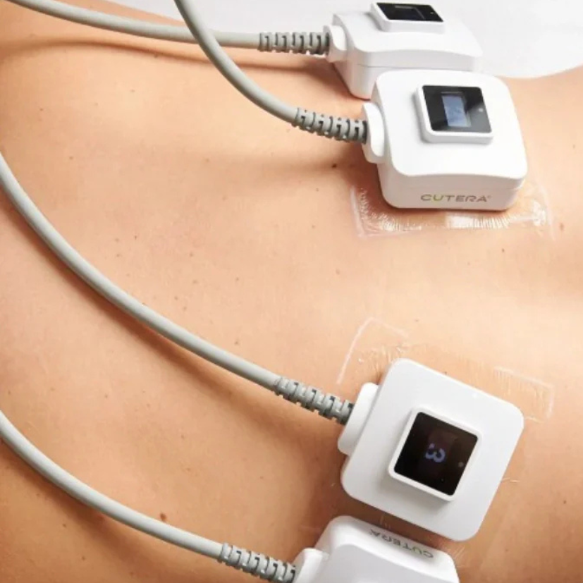 Monosculpt Zsírbontás