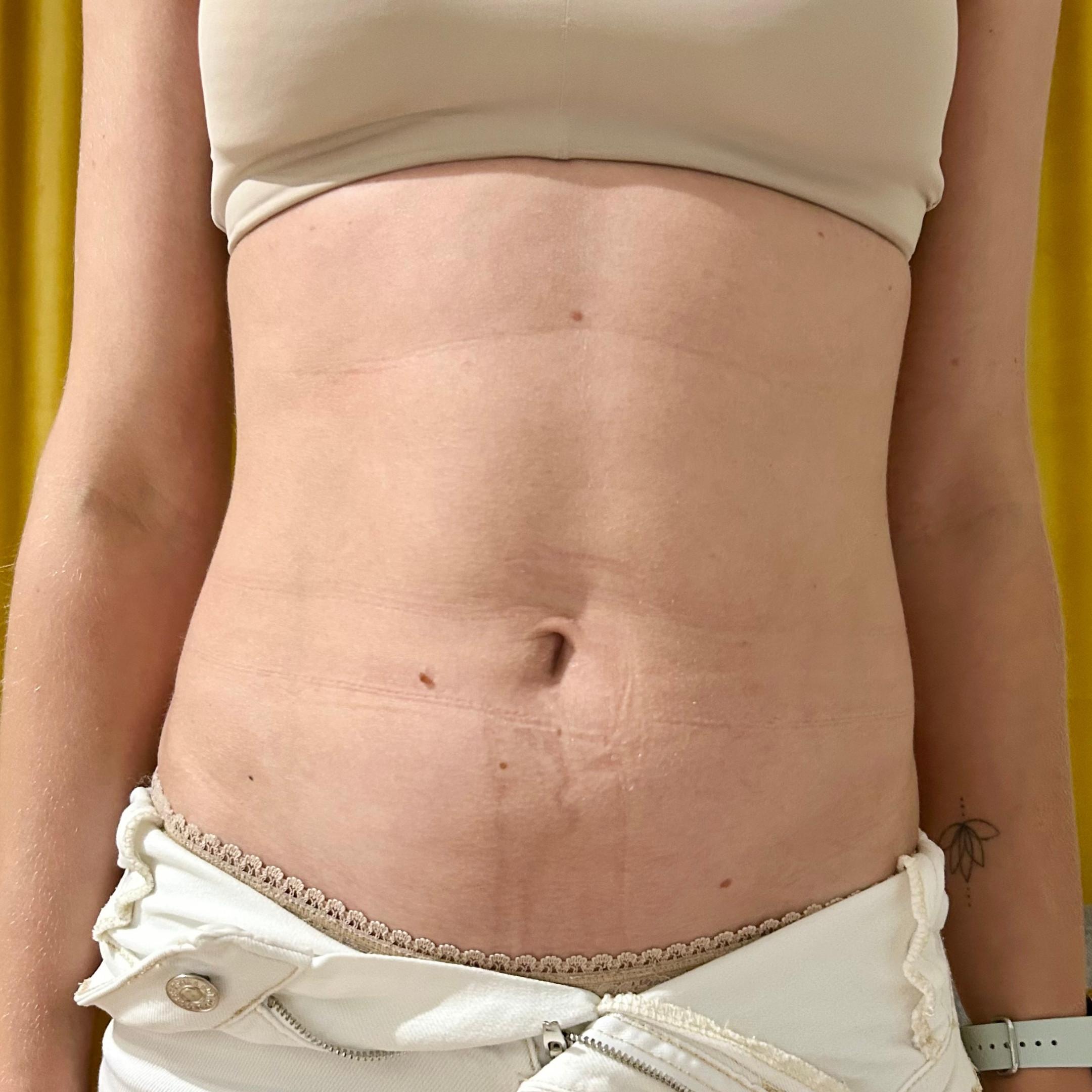 Előtte kép hasi terület formálása előtt a SHAPE HAUS-ban