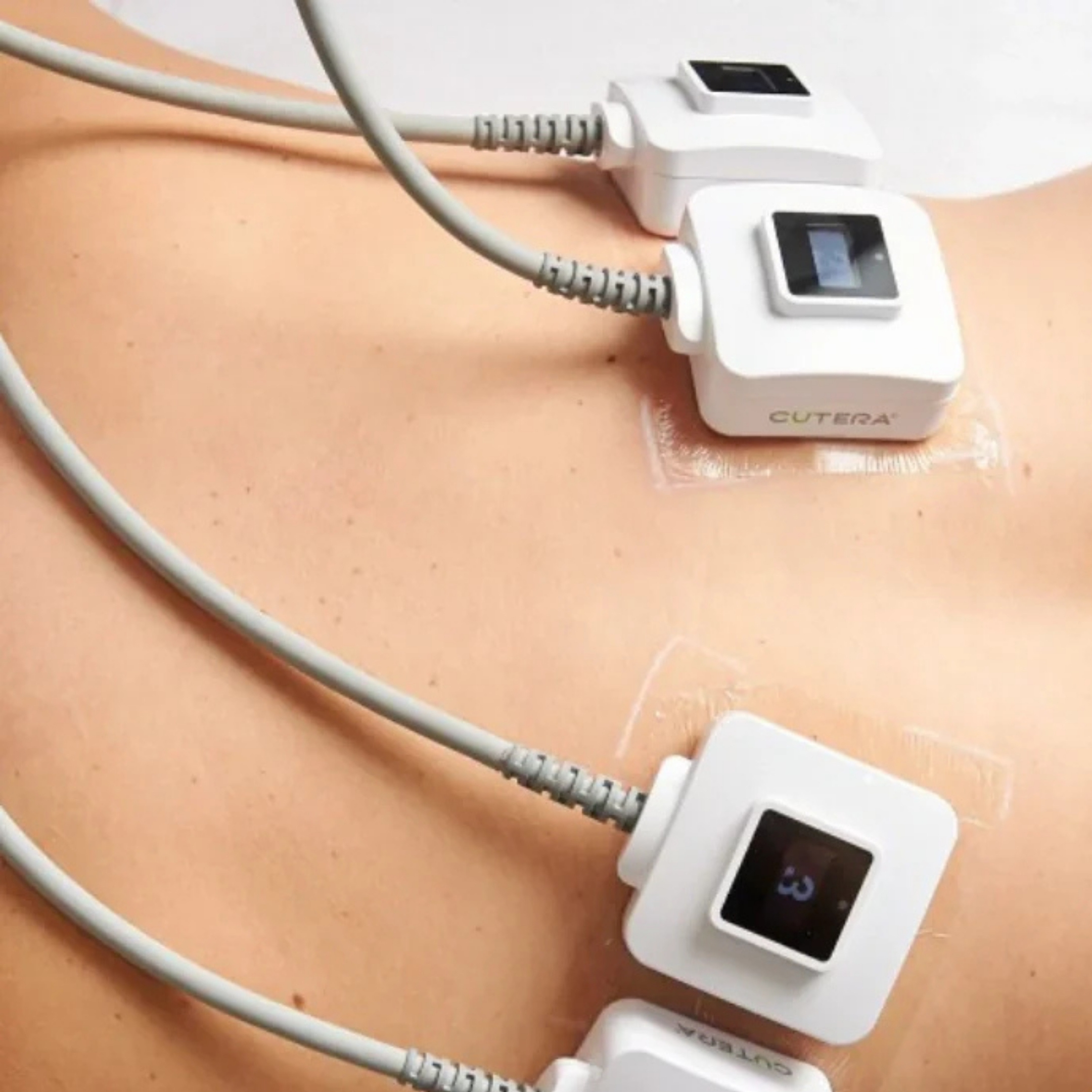 Monosculpt hasi alakformáló kezelés a SHAPE HAUS-ban